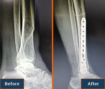 Fracture Fixation