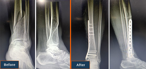 Fracture Fixation