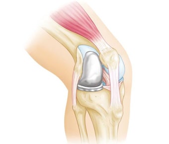 Partial Knee Replacement