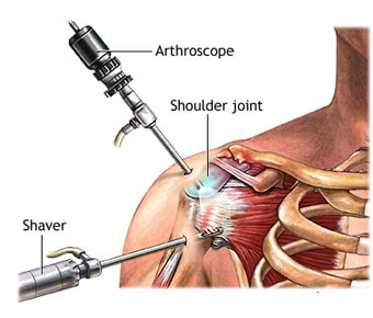 Shoulder & knee Arthroscopy