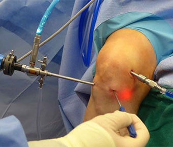 Key Hole Surgery